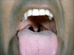 Tongue atrophy after drinking Mayhem